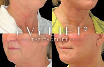 female patient before and after EVELift®