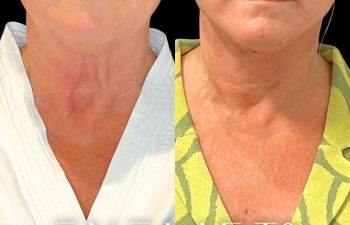 female patient before and after EVELift®