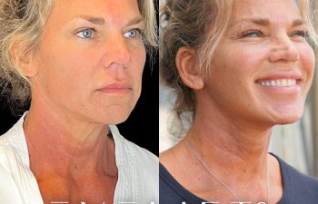 female patient before and after EVELift®