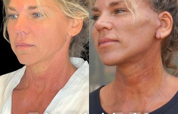 female patient before and after EVELift®