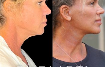 female patient before and after EVELift®