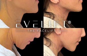 female patient before and after EVELift®