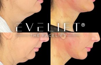 female patient before and after EVELift®
