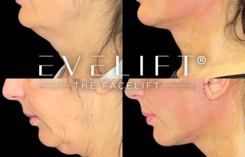 female patient before and after EVELift®