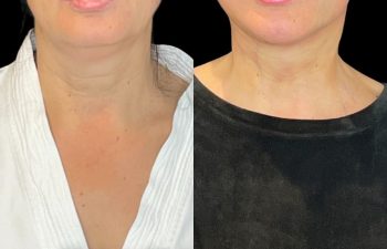 female patient before and after EVELift®