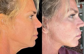 female patient before and after EVELift®