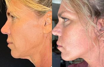 female patient before and after EVELift®