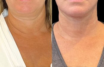 female patient before and after EVELift®