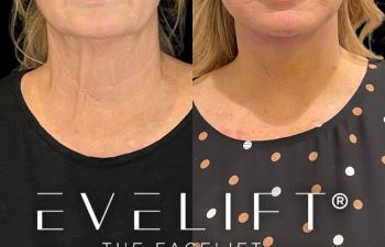 female patient before and after EVELift®