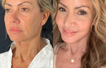 female patient before and after EVELift®