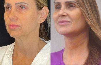 female patient before and after EVELift®