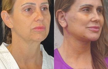 female patient before and after EVELift®