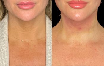 female patient before and after EVELift®