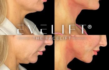 female patient before and after EVELift®
