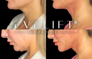 female patient before and after EVELift®