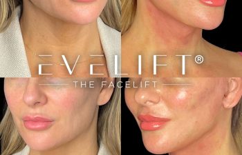female patient before and after EVELift®