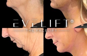 female patient before and after EVELift®