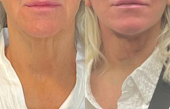 female patient before and after EVELift®
