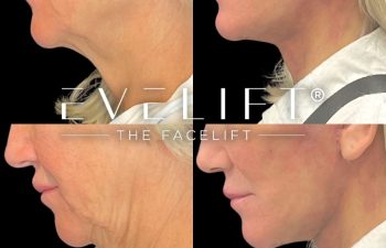 female patient before and after EVELift®