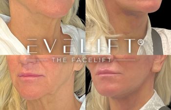 female patient before and after EVELift®
