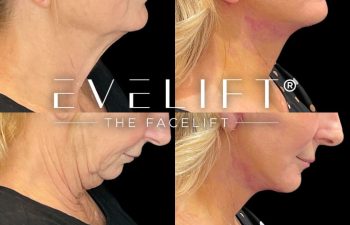 female patient before and after EVELift®