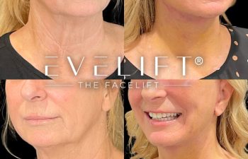 female patient before and after EVELift®