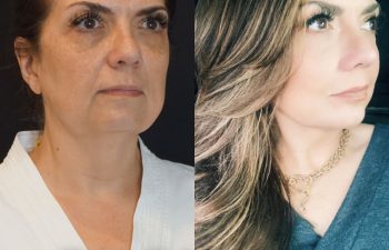 female patient before and after EVELift®