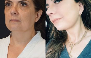 female patient before and after EVELift®