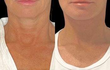 female patient before and after EVELift®