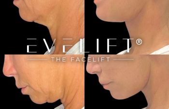 female patient before and after EVELift®