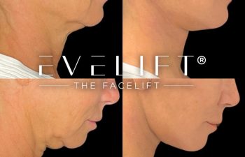 female patient before and after EVELift®