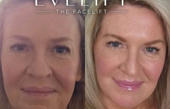 female patient before and after EVELift®