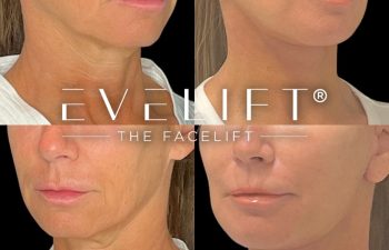 female patient before and after EVELift®