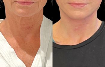 female patient before and after EVELift®