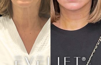 female patient before and after EVELift®