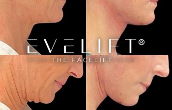 female patient before and after EVELift®