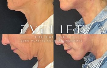 female patient before and after EVELift®