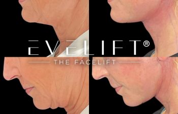 female patient before and after EVELift®