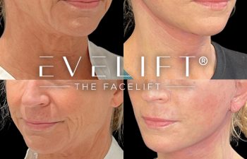 female patient before and after EVELift®