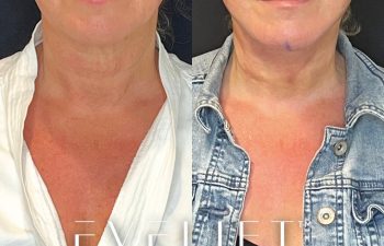 female patient before and after EVELift®