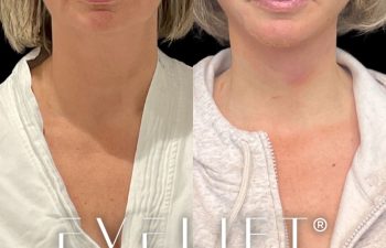 female patient before and after EVELift®