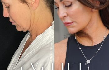 female patient before and after EVELift®