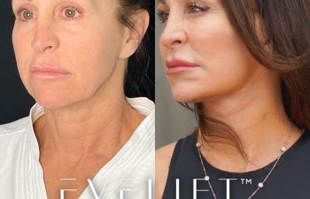 female patient before and after EVELift®