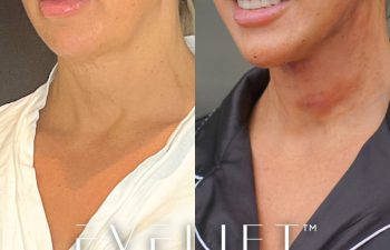 female patient before and after EVELift®