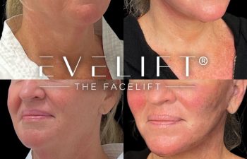 female patient before and after EVELift®