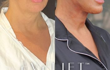 female patient before and after EVELift®