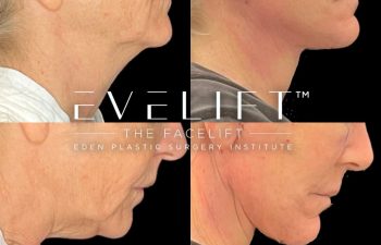 female patient before and after EVELift®