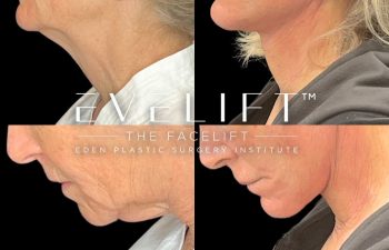 female patient before and after EVELift®