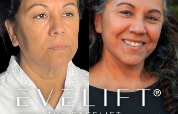 female patient before and after EVELift®