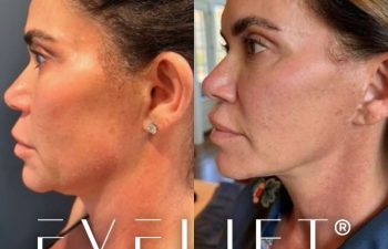 female patient before and after EVELift®